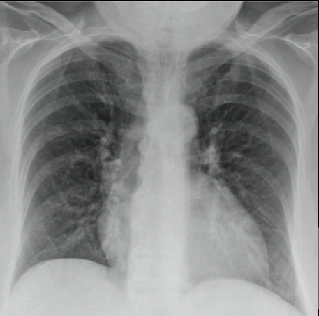 <p>1) Se realiza decúbito supino</p><p>2) sirve para ver neumotórax o derrame pleural</p>