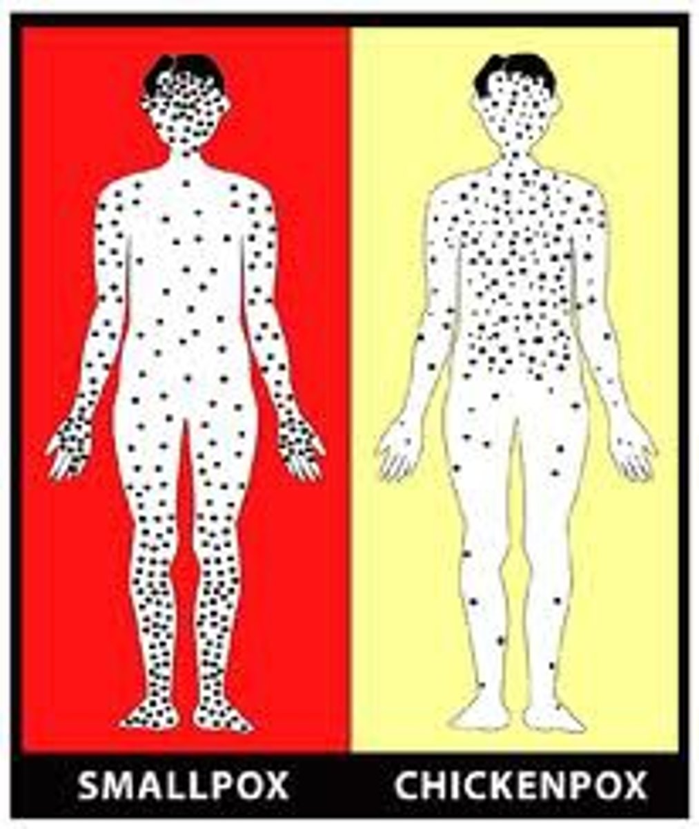 <p>Eradicated disease compared to chicken pox</p><p>- contagious until lesions are dried</p><p>- Same stage lesions</p><p>- starts in face and spreads down</p><p>- sicker pt</p><p>Airborne Precautions</p>