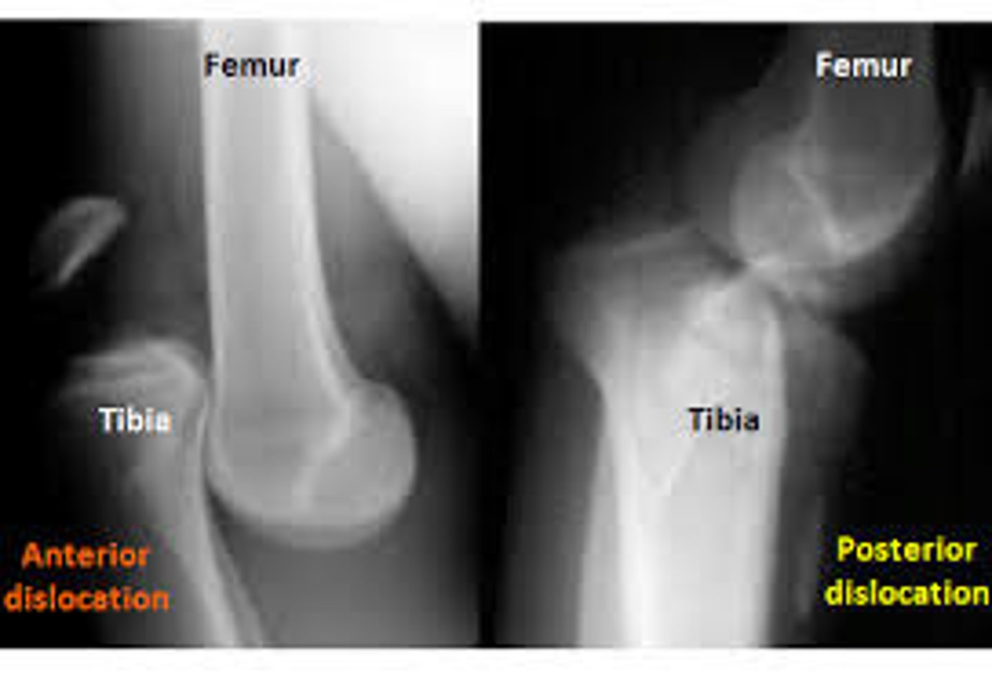 <p>popliteal artery injury (and compartment syndrome)</p><p>any vascular compromise = stat vascular sx consult</p>