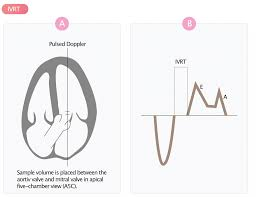 <p>this image demonstrates how to obtain and measure what diastolic parameter:</p>