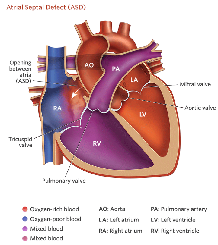 <p><strong><u>Increased</u> Pulmonary Blood Flow</strong></p><ul><li><p class="">Hole in the wall dividing the left and right atria.</p></li><li><p class="">Often asymptomatic.</p><ul><li><p class="">Unless it is extreme, in which they will develop signs and symptoms of heart failure.</p></li></ul></li><li><p class=""><strong>Increased blood flow results in</strong>:</p><ul><li><p class="">Shortness of Breath (SOB)</p></li><li><p class="">Fatigue</p></li><li><p class="">Failure to Thrive (FTT) over time.</p></li></ul></li><li><p class="">Repairs are usually performed around 2 to 3 years of age.</p></li></ul><p></p>
