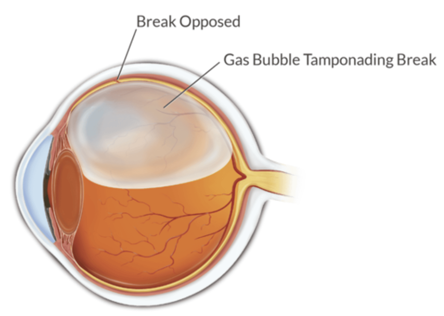 <p>sulfur hexafluoride - this functions as a splint to hold the retina in place while healing occurs</p><p>- N2O can diffuse in, expand the bubble, compromise retinal perfusion and cause permanent blindness</p>