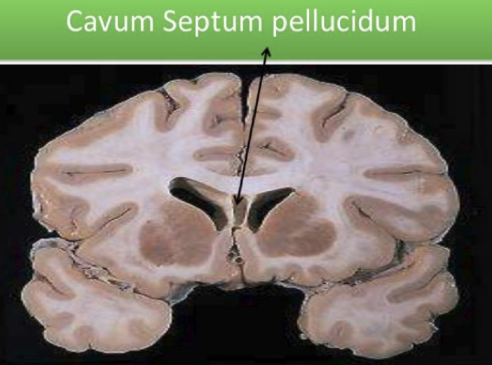 Cavum septum pellucidum