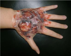 3rd degree burns