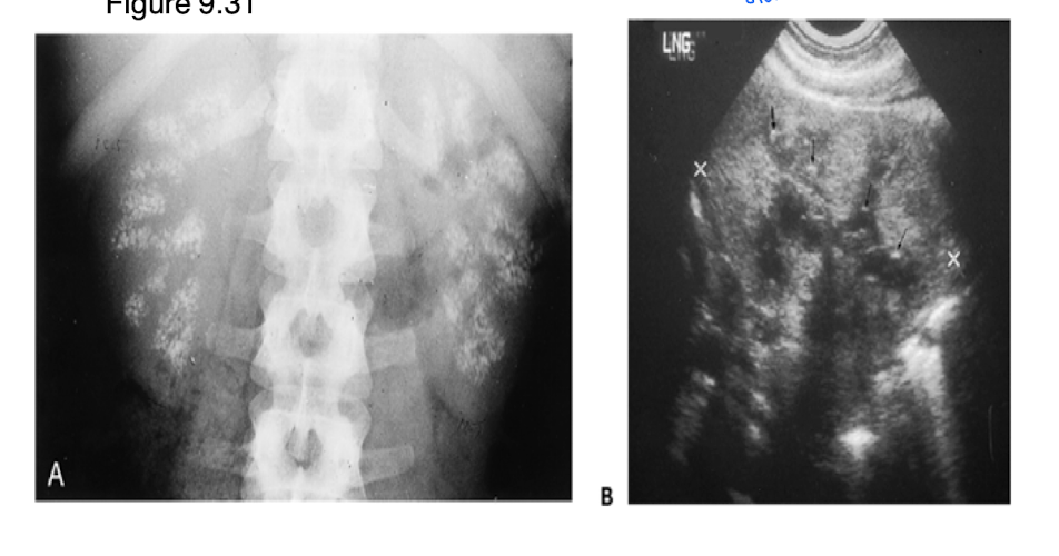 <ul><li><p>calcium deposits in renal tissue due to increased serum calcium</p></li><li><p>Uniform opacity, bilateral, and stone is clear, and precise</p></li></ul><p></p>