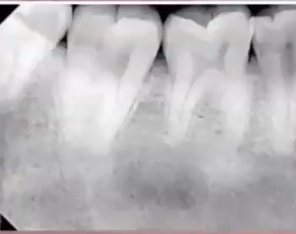<p>what is the description of this radiographic feature? </p>