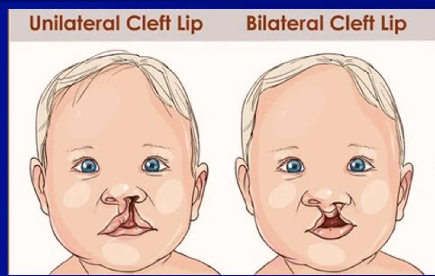 <p>Is unilateral or bilateral cleft lips (CP) more prevalent? </p>