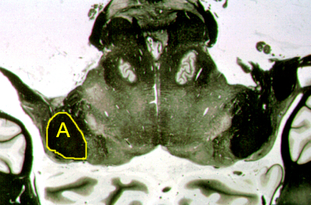 <p>Identify the structure indicated by the outline and letter "A".</p><p><span>A. Pyramid</span></p><p><span>B. Middle cerebellar peduncle</span></p><p><span>C. Inferior cerebellar peduncle</span></p><p><span>D. Dorsal cochlear nucleus</span></p><p><span>E. Inferior vestibular nucleus</span></p><p></p>