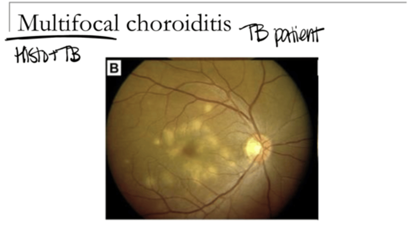<p>Multifocal Choroiditis (Pic)</p>