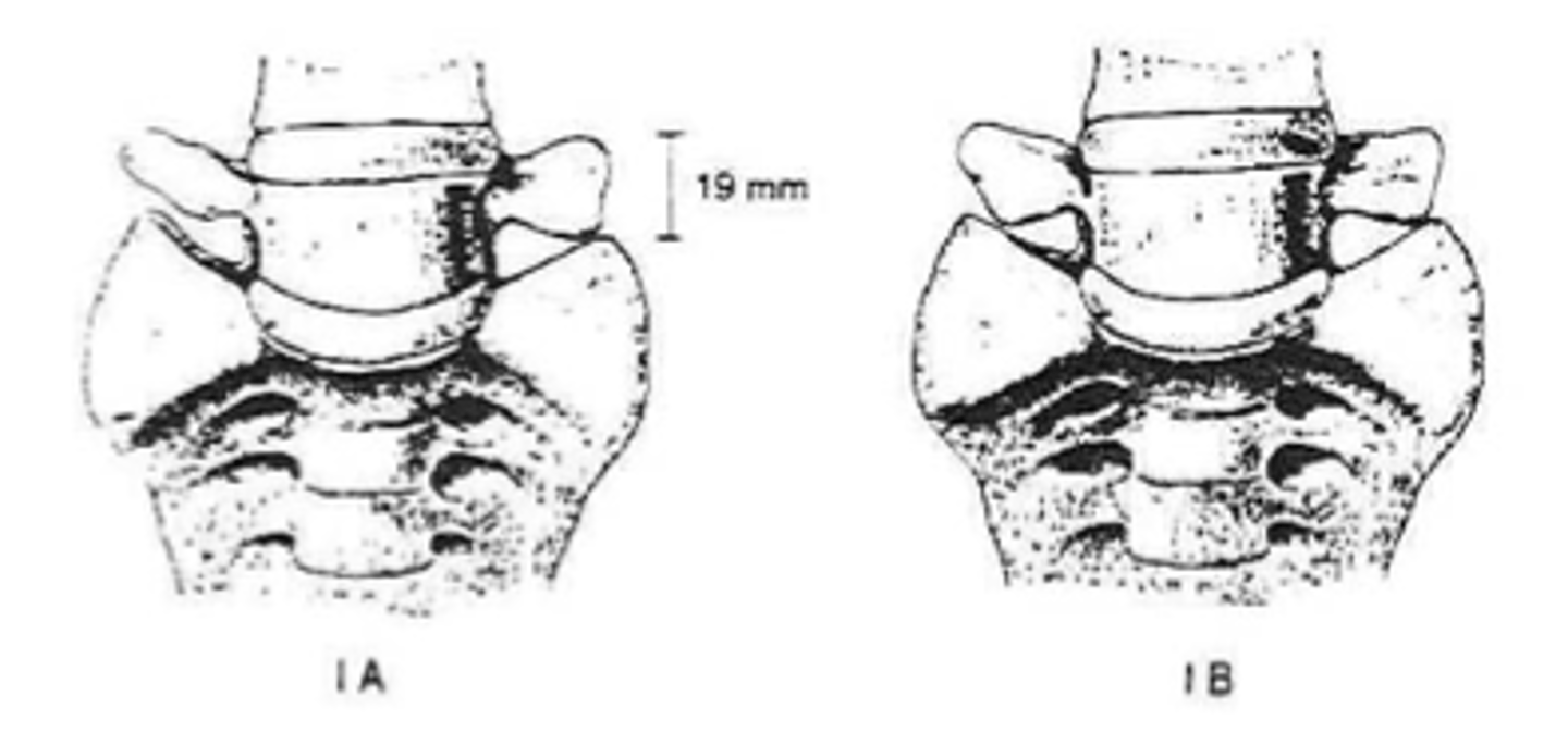 <p>- Spatulated transverse processes</p><p>- No articulation</p><p>- No fusion</p><p>- No predisposition to disc herniation</p>