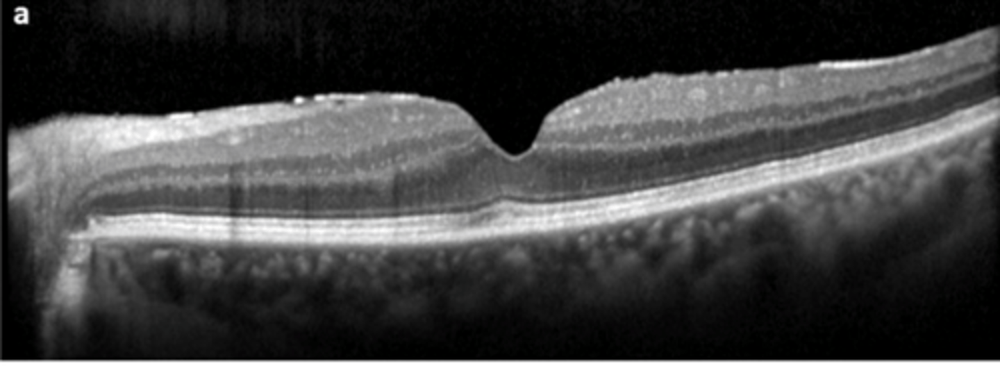 <p>hyperreflective membrane within ILM (between RNFL and posterior hyaloid of vitreous) = more hyperR than vitreous face but same reflectivity as rNFL</p>