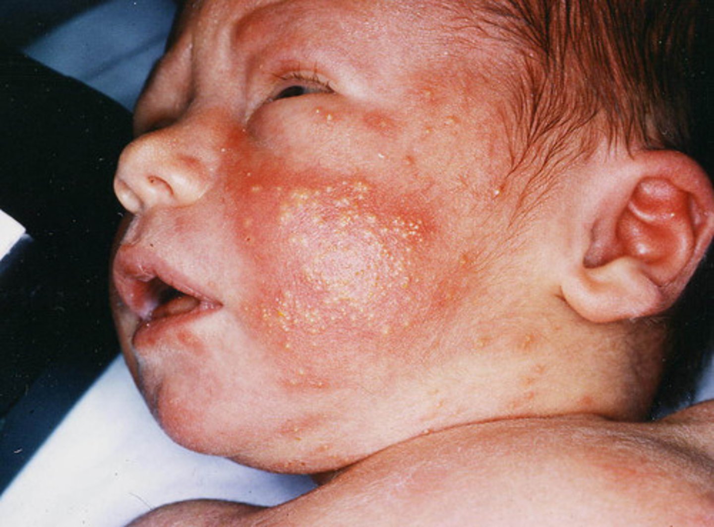 <p>"Flee-bitten lesion" - Pink rash with firm,</p><p>yellow-white papules or pustule; usually appears 24 to 48 hours after birth and disappear in a few days</p>