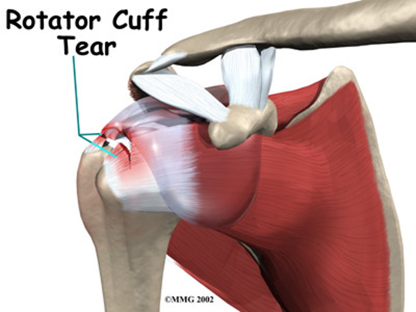 <p>inflammation of the rotator cuff in the shoulder caused by overuse</p>