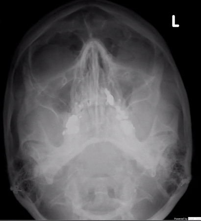 <p>injury on patient’s left</p>