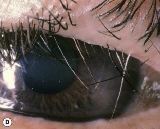 <p>When meibomain glands turn into hair follicles after severe conjunctival inflammation</p>