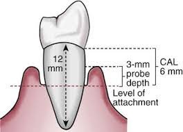 <p>Clinical Attachment Loss (CAL)</p>