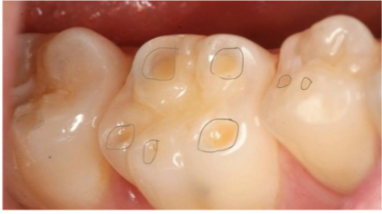 <p>distinct defect; hard tissue loss involving <50% of the surface area (only molar) </p>
