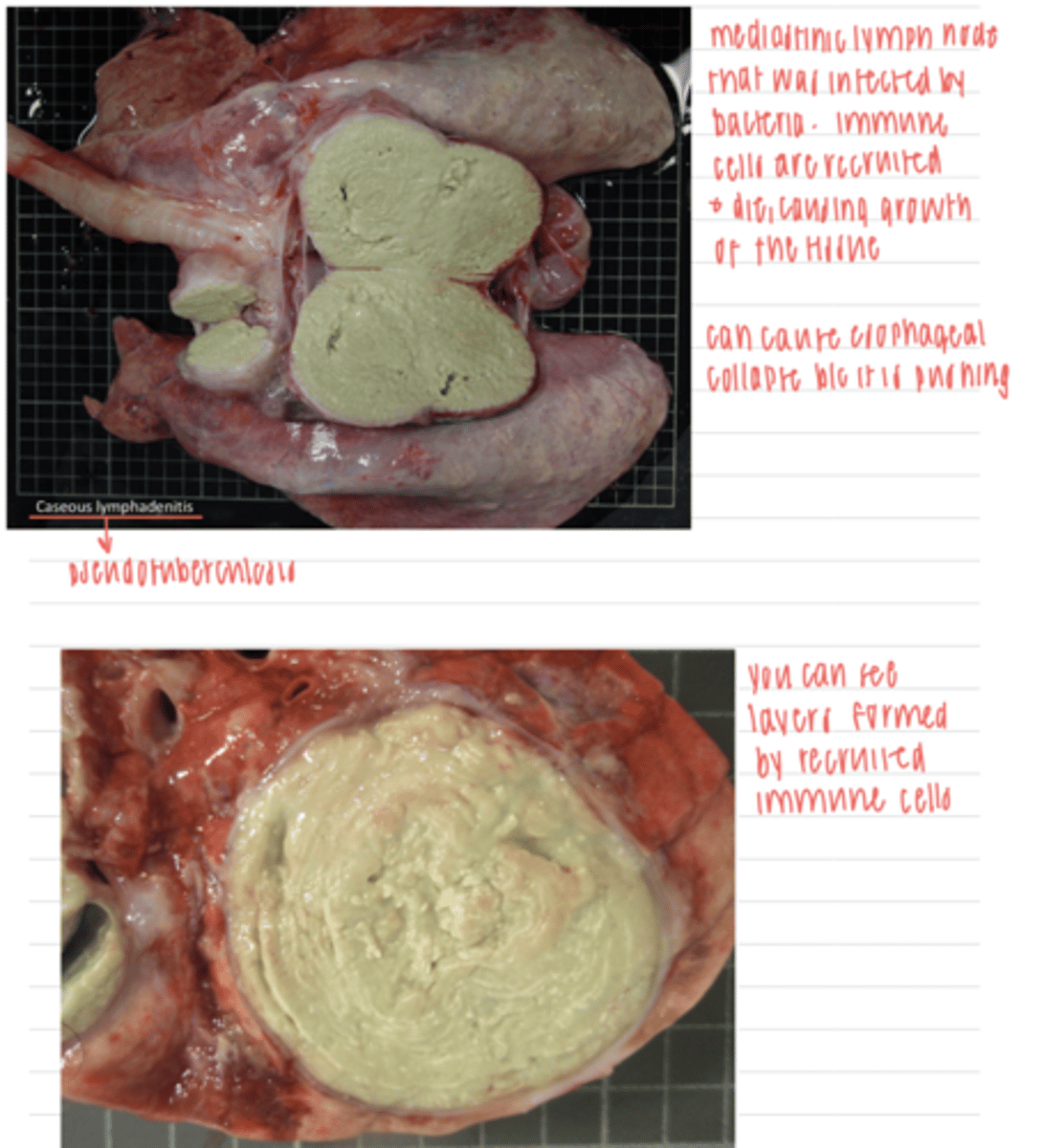 <p>more immune cells are recruited and die, causing growth of the tissue. the tissue also hardens because it accumulates calcium ("dystrophic calcification")</p>