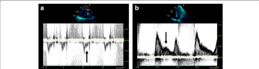 <p>What diagnosis is consistent with this spectral Doppler?</p><p>What sign is seen?</p>