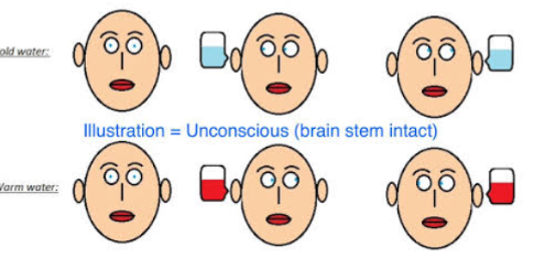 <p>It assesses brainstem function in comatose patients. The intact external auditory canal is filled with ice-cold water. Both eyes will move toward the cold ear and then snap back to the center if brainstem function is normal.</p>