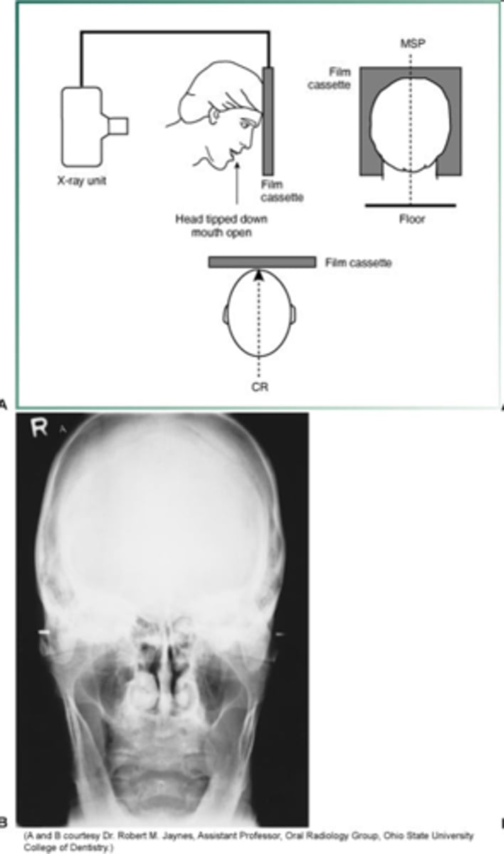 <p>identify fractures of the condylar neck and ramus</p>