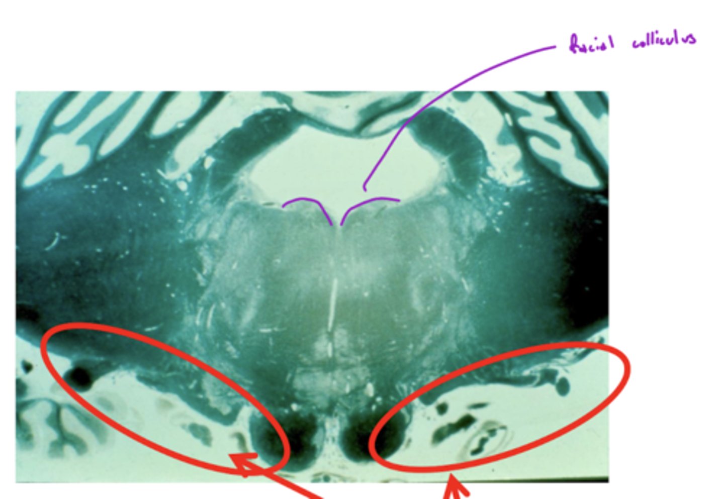<p>bumps (hills) coming out from dorsal pontomedullary junction into the 4th ventricle -- CN VII SVE fibers create this space when they wrap around the abducens nucleus</p>