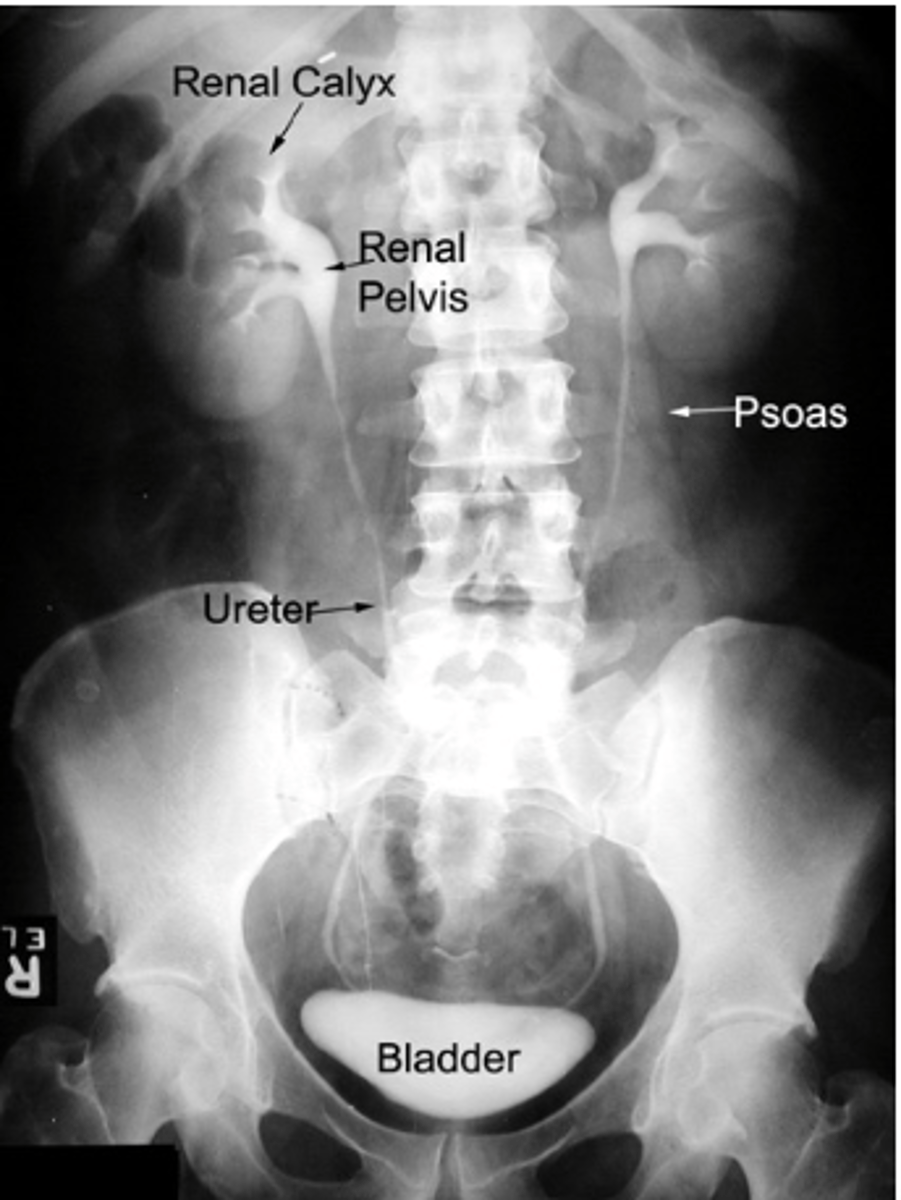 <p>Renal veins are normally anterior to the renal arteries.</p>