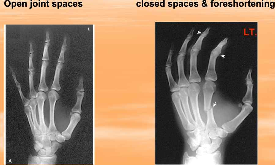 <p>1. Keeps joint spaces open </p><p>2. Prevent foreshortening</p>