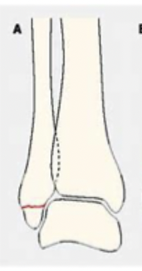 <p>Describe a Weber A</p>