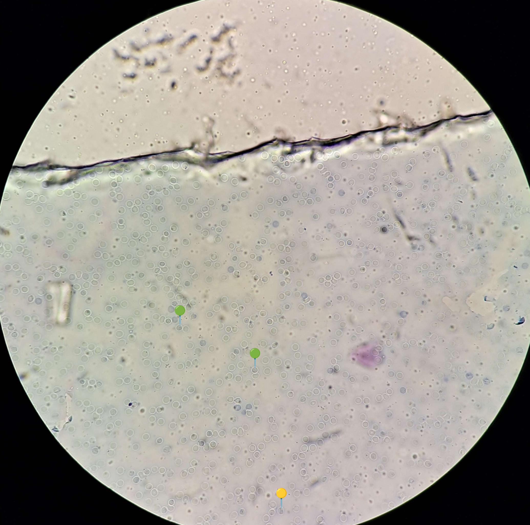 <p><strong><em>Babesia canis</em></strong></p><p><span data-name="yellow_circle" data-type="emoji">🟡</span> - Tetrada merozoitów (krzyż maltański)</p><p><span data-name="green_circle" data-type="emoji">🟢</span>- Stadium pierścienia</p><p></p><p class="is-empty"></p><p><strong>Parazytoza: </strong><em>Babeszjoza</em></p>