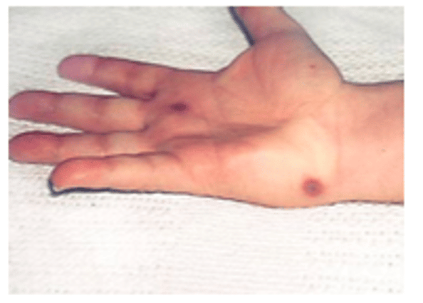 <p>painful immune-complex depositions</p>