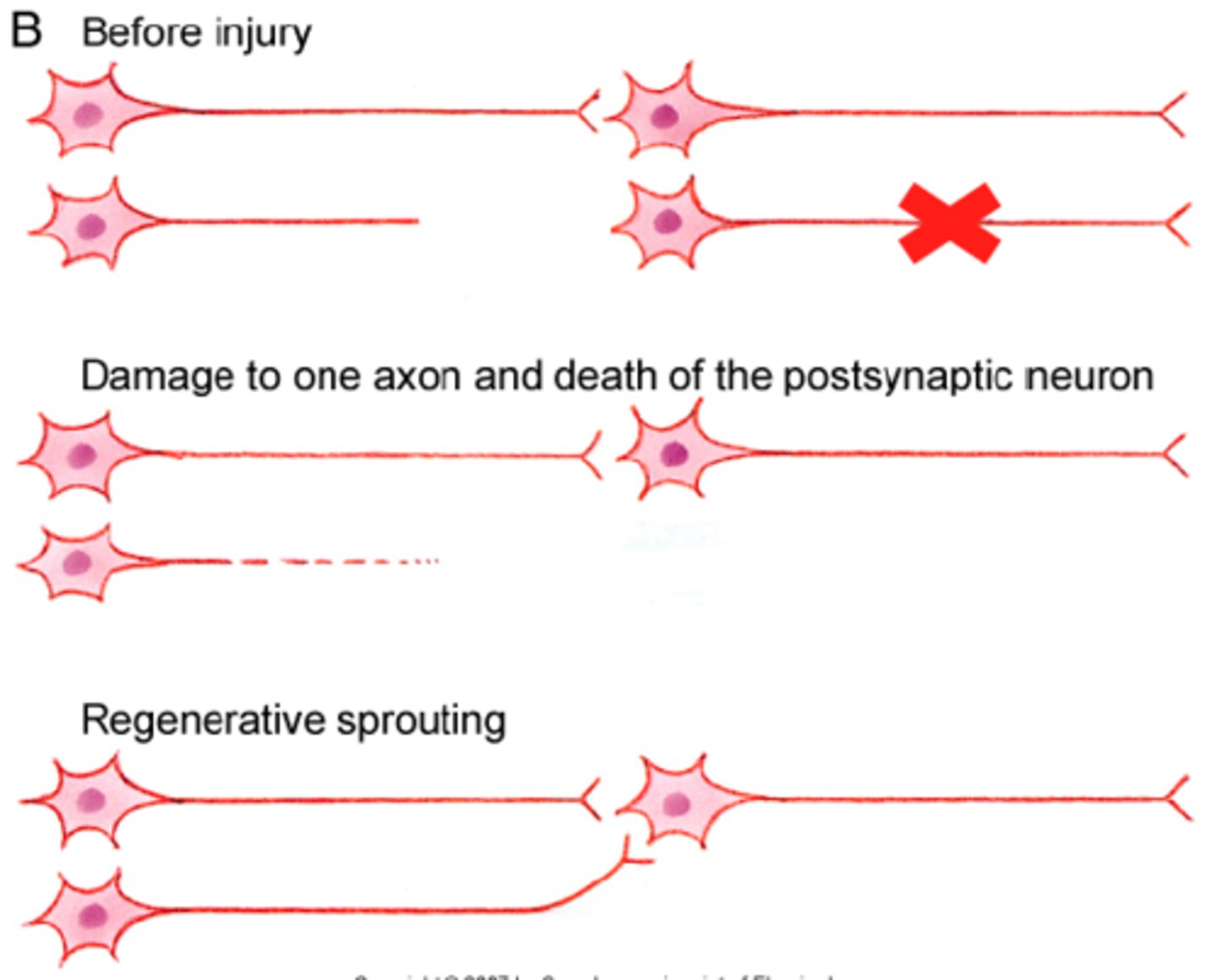 <p>occurs when an axon and its target cell have been damaged and the injured axon sends out side sprouts to a new target</p>
