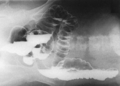 <p>What is this x-ray demonstrating?</p>