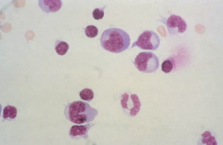 Figure 8: Lymphocytes and monocytes with dark blue cytoplasms during viral meningitis