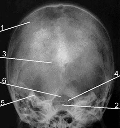 <p>On this image of the skull, the dorsum sella is indicated by number:</p><p>a.</p><p>b. 4</p><p>c. 3</p><p>d. 6</p><p>e. 5</p><p>f.  2</p><p>g.  1</p>