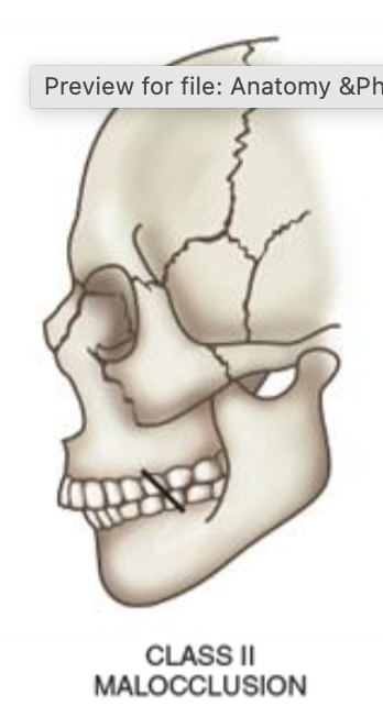 <ul><li><p>relatively retracted mandible</p></li><li><p>may be product of relative micrognathia (undersized jaw)</p></li></ul><p></p>