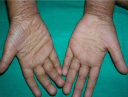 <p>What’s this called &amp; what’s it a sign of</p>