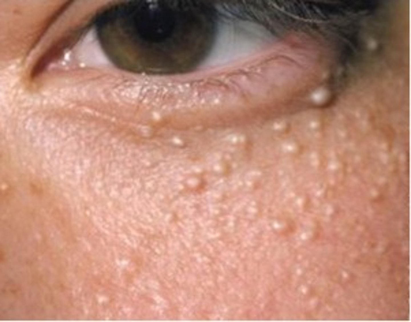 <p>whitish, pearl-like masses of sebum; usually found around the eyes, cheeks and forehead</p>