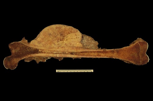 <ol><li><p>Gross appearance of osteosarcoma</p></li><li><p>Site of origin in bone</p></li></ol><p></p>