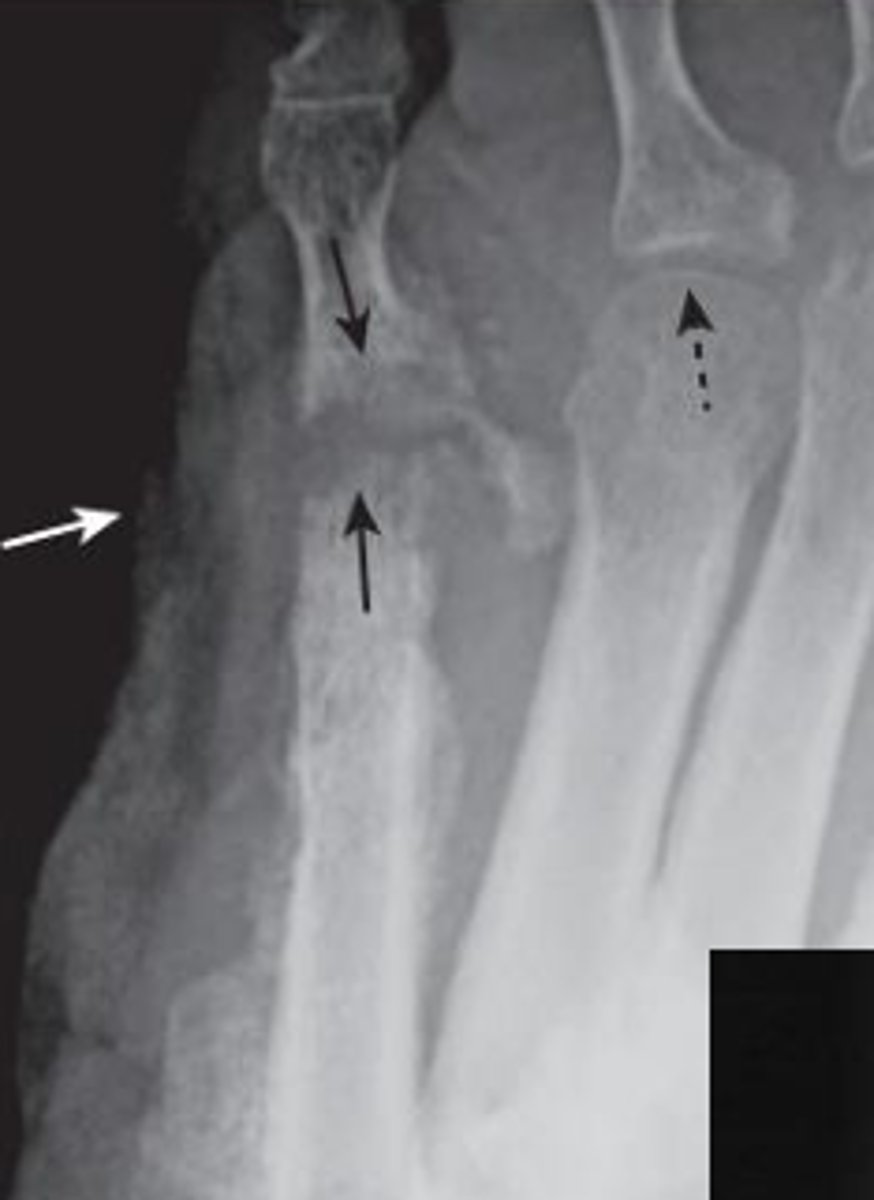 <p>What pathology is seen here?</p>