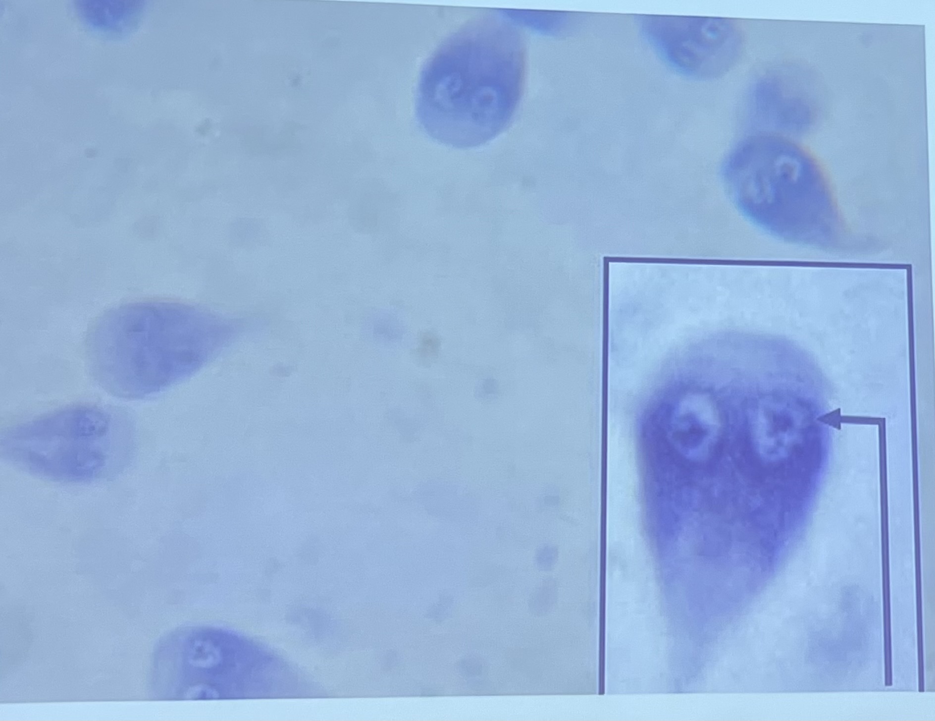 <ul><li><p><mark data-color="yellow" style="background-color: yellow; color: inherit">Trophozoite</mark>: sting ray shaped, 2 nuclei w/ karyosomes, flagella</p></li><li><p><mark data-color="yellow" style="background-color: yellow; color: inherit">Cyst</mark>: 2-4 nuclei w/ karyosomes, median body </p></li></ul><p></p>