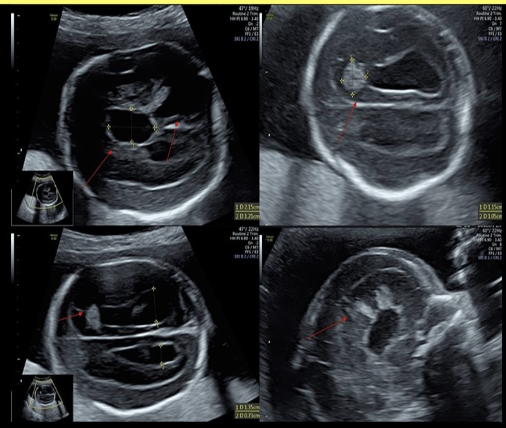 <p>which describes the <strong>early</strong> appearance of intracranial <strong>hemorrhage</strong> in a fetus? </p><p>.</p><p>blood <strong>first appears</strong> as</p><p>.</p><p>a) anechoic fluid</p><p>b) hypoechoic fluid</p><p>c) hyperechoic fluid</p><p>d) complex cystic area of fluid</p>