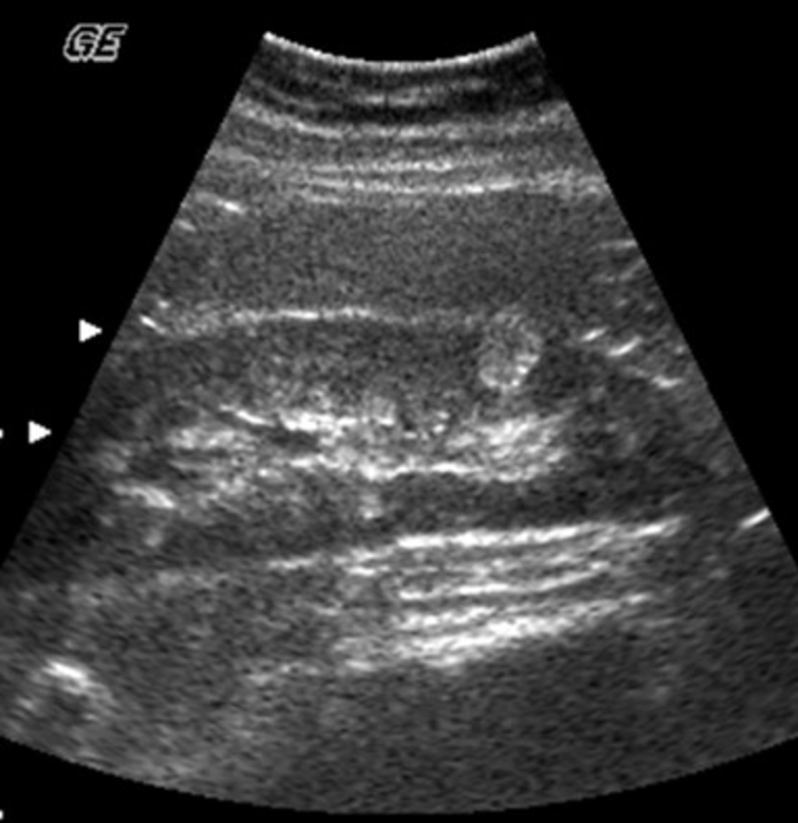 <p>Which of the following is most consistent with the sonographic appearance of this renal mass?</p><p>a. angiomyolipoma</p><p>b. staghorn calculus</p><p>c. lymphomatous involvement</p><p>d. complex renal cyst</p><p>e. transitional cell tumor</p>