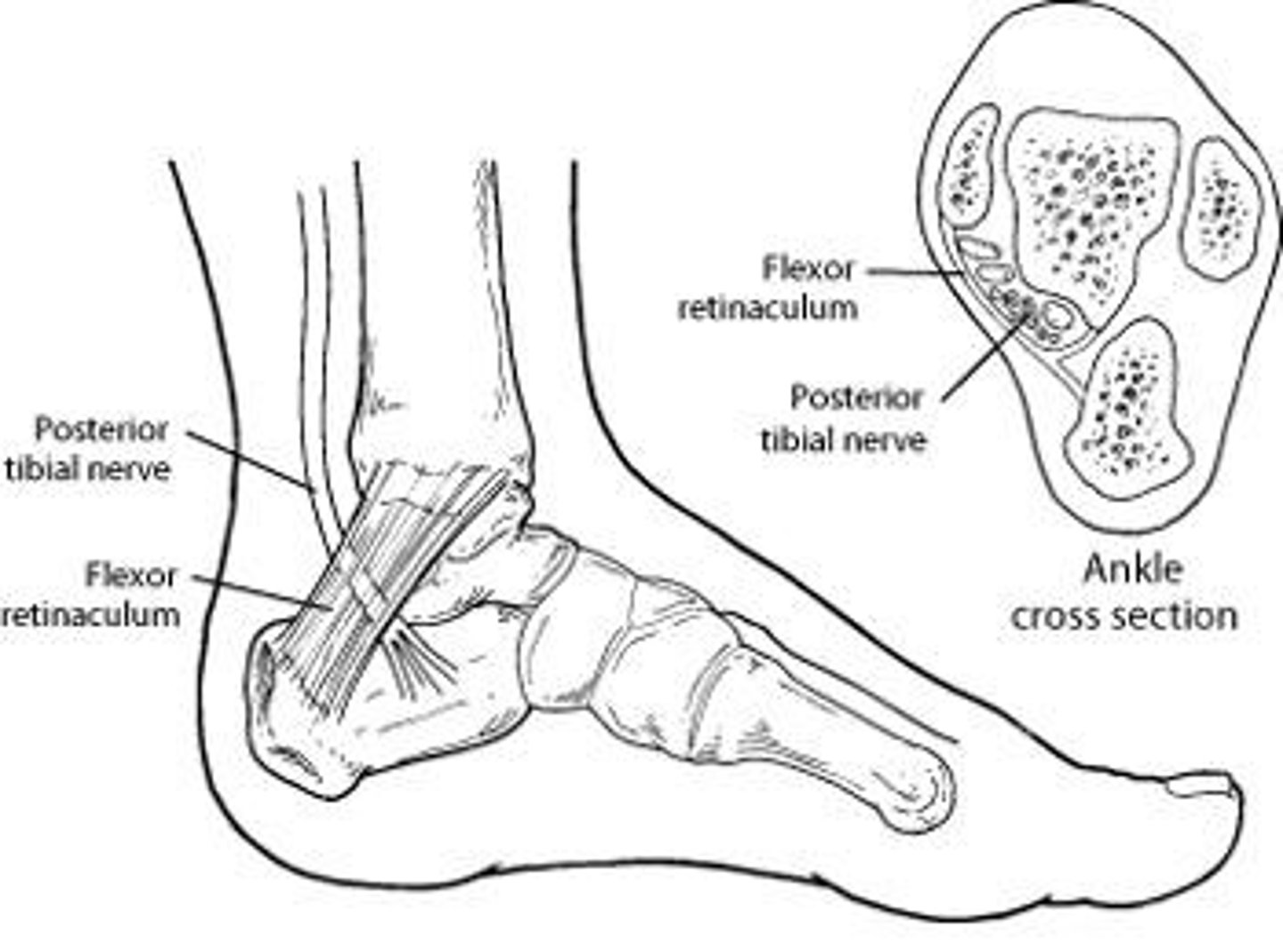 <p>A condition where neurovascular structures are compressed as they pass through a narrow space, leading to symptoms like numbness and pain.</p>