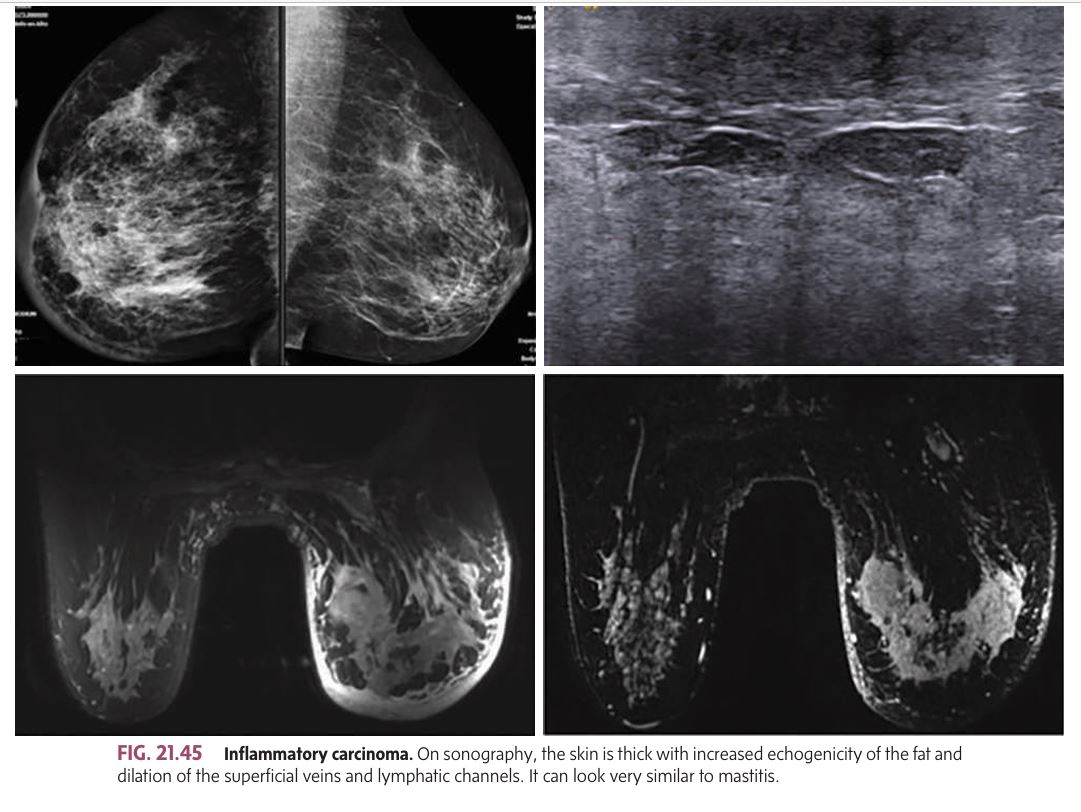 <p class=""><br>A rare, highly malignant cancer that <strong>blocks lymphatic channels in the skin</strong>, causing rapid metastasis and poor prognosis.</p><p class=""><strong>Signs &amp; Symptoms:</strong></p><ul><li><p class="">Red, swollen breast</p></li><li><p class="">Peau d’orange (orange peel texture) in 1/3 of cases</p></li><li><p class="">Skin is warm/feverish, breast is hard</p></li><li><p class="">Enlarged axillary lymph nodes</p></li></ul><p class=""><strong>Sonographic Features:</strong></p><ul><li><p class="">Thickened skin with increased echogenicity of the fat.</p></li><li><p class="">Dilation of superficial veins and lymphatic channels.</p></li><li><p class="">May resemble mastitis, making it difficult to distinguish without biopsy.</p></li></ul><p class=""><strong>Prognosis:</strong><br>Poor, due to rapid and diffuse metastasis.</p><p></p>