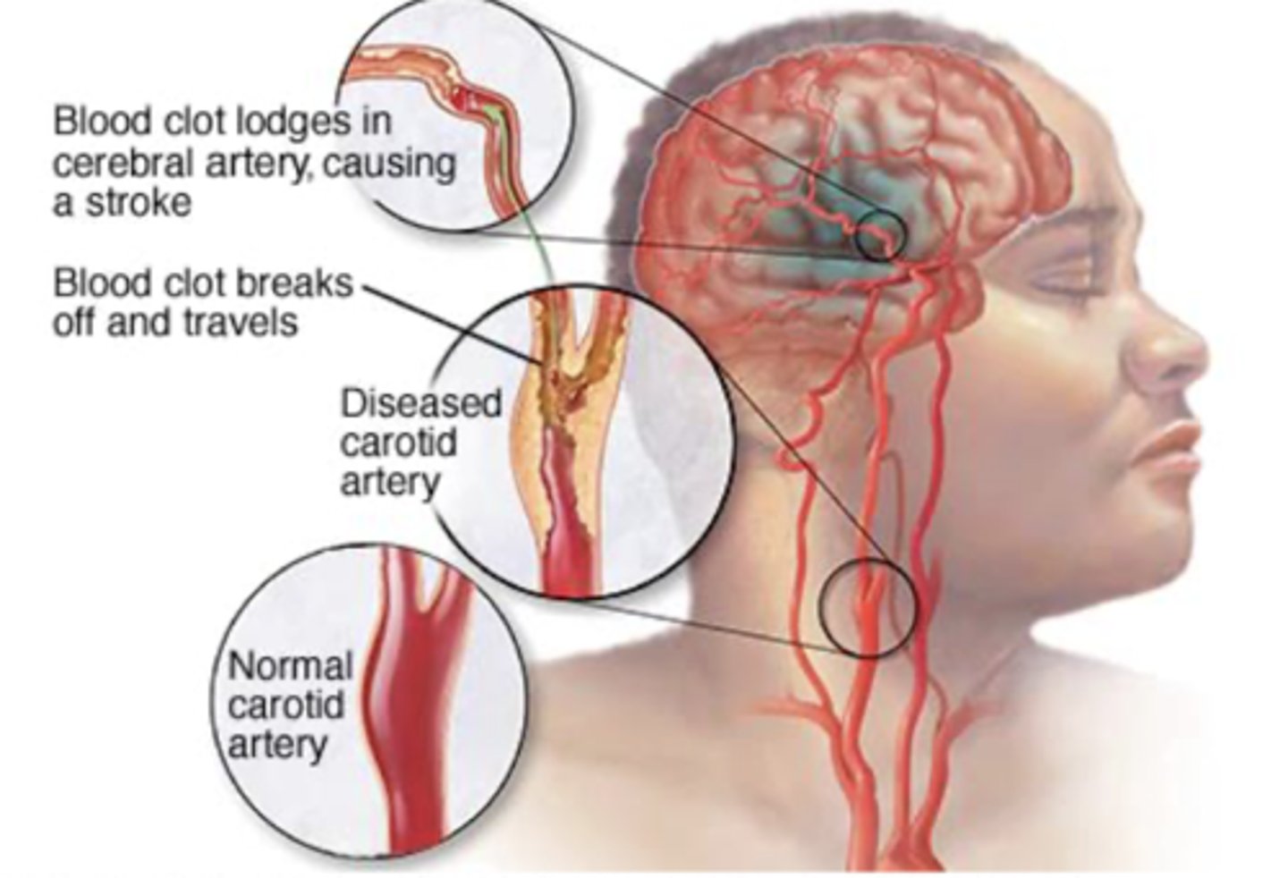 <p>Occurs when a blood vessel that carries oxygen and nutrients to the brain is either blocked by a clot or bursts (or ruptures) </p><p>= Cerebrovascular accident </p>