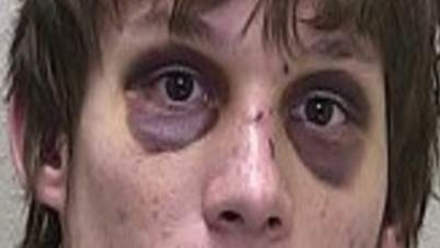 <p>Bruising around the eyes, indicative of a basilar skull fracture</p>