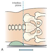 <p>interiliac plane </p>