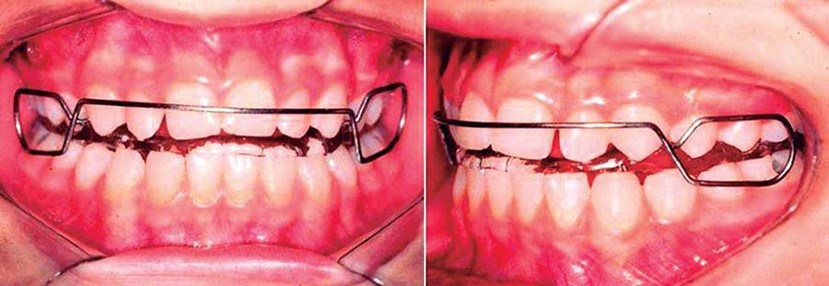 <p>Correct Class 2 occ</p><p>Removable</p><p>Active</p>