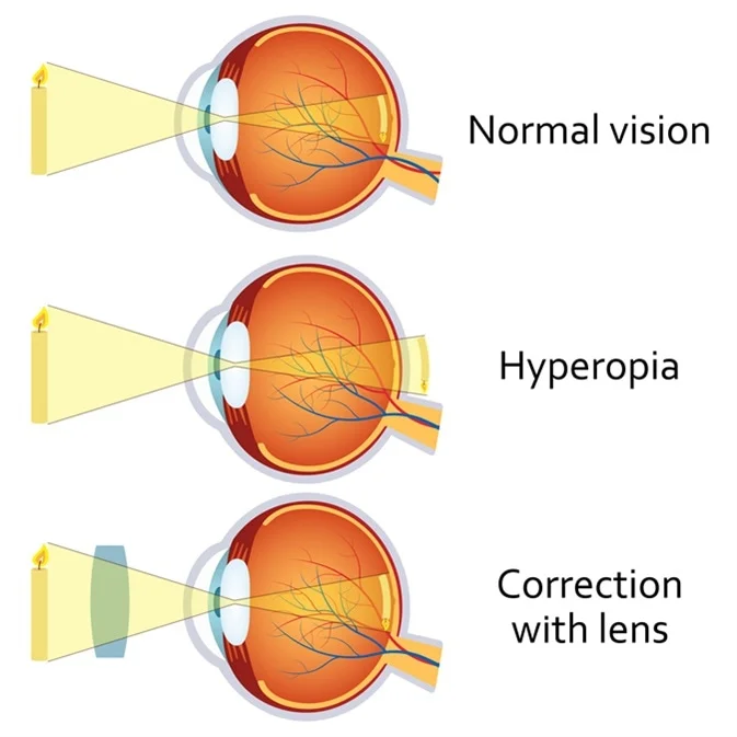 farsighted

eyeball too short

focal point behind retina